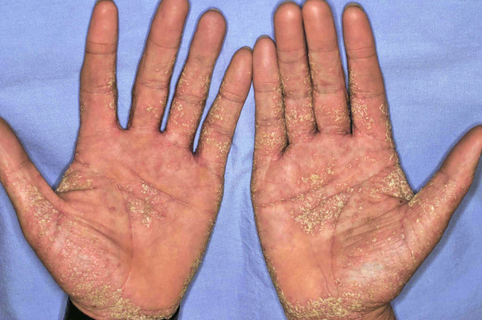 ダニ 疥癬 疥癬の症状と期間（疥癬どれくらいで治る？）
